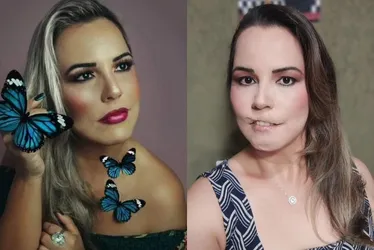 Imagem ilustrativa da imagem Mulher perde o lábio superior após fazer preenchimento com PMMA