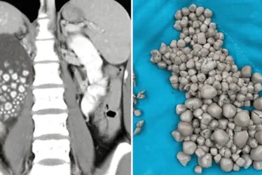 Imagem ilustrativa da imagem Pedra nos rins atinge cada vez mais crianças, diz médico