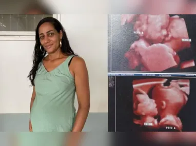 Imagem ilustrativa da imagem Mulher descobre gravidez de gêmeas que dividem um só coração