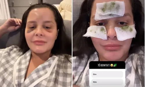 
          Imagem ilustrativa da imagem Após quebrar o nariz, Maraisa mostra hematomas no rosto e brinca: 'Estou bonita?'
          