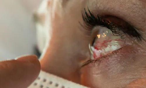 
          Imagem ilustrativa da imagem Explosão de casos: hospitais do Recife registram aumento de conjuntivite
          