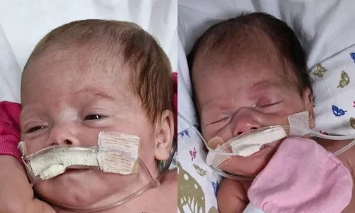 
          Imagem ilustrativa da imagem Gêmeos de Colatina: Eloá e Maytê vão receber alta do hospital nesta quarta-feira
          