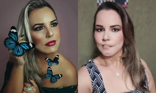 
          Imagem ilustrativa da imagem Mulher perde o lábio superior após fazer preenchimento com PMMA
          