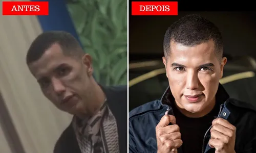 
          Imagem ilustrativa da imagem Técnicas mais indicadas para combater olheiras
          