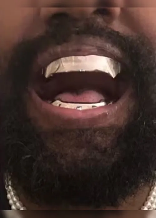 Imagem ilustrativa da imagem Kanye West coloca prótese de titânio de R$ 4 milhões nos dentes