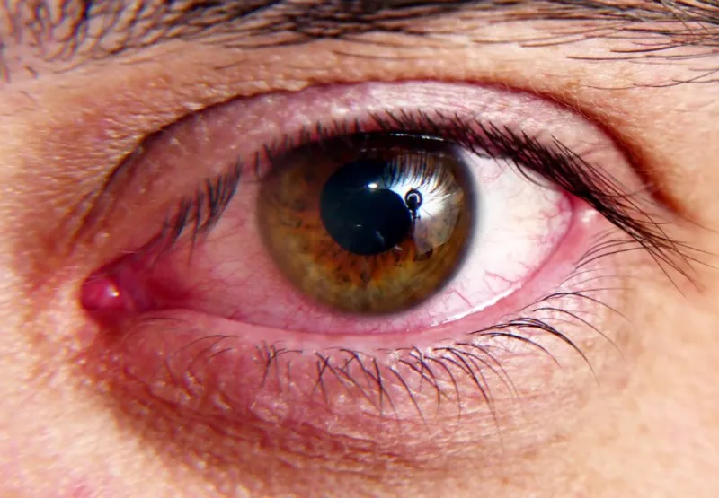 A síndrome do olho seco é uma condição na qual a quantidade ou qualidade das lágrimas produzidas pelo olho é insuficiente para manter a superfície ocular adequadamente lubrificada