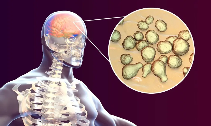 Imagem ilustrativa da imagem Meningite: conheça as causas, os sintomas e as formas de evitar a doença