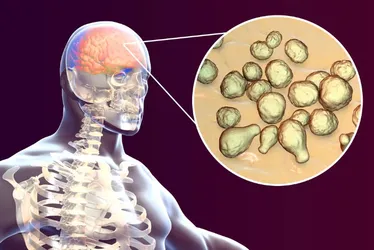 Imagem ilustrativa da imagem Meningite: conheça as causas, os sintomas e as formas de evitar a doença