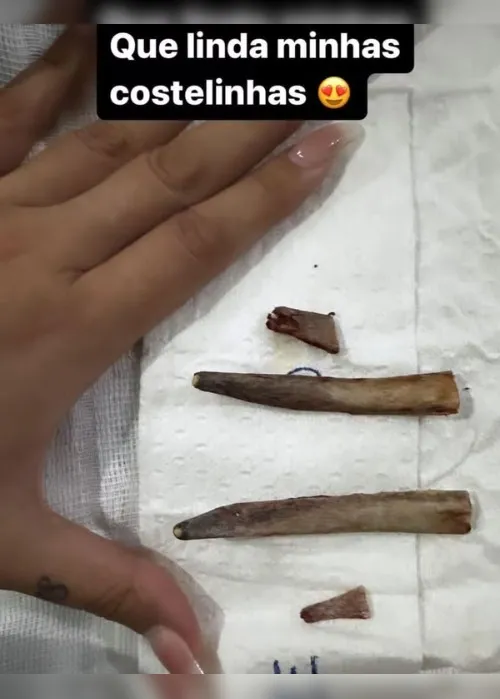 Imagem ilustrativa da imagem Andressa Urach mostra foto de costelas removidas em procedimento: "Era um sonho"