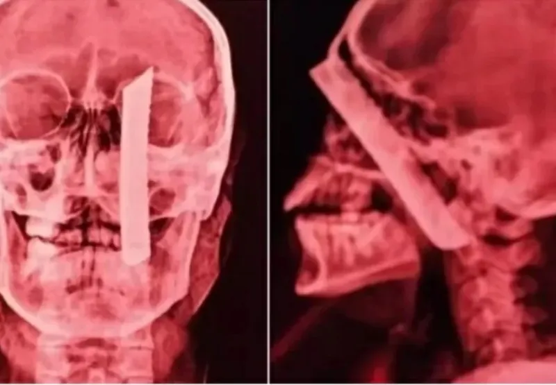 Foto de raio-x mostra a lâmina enfiada na cabeça da vítima