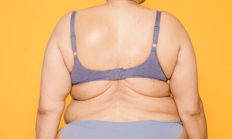 Imagem ilustrativa da imagem Obesidade: tratamento requer envolvimento do poder público