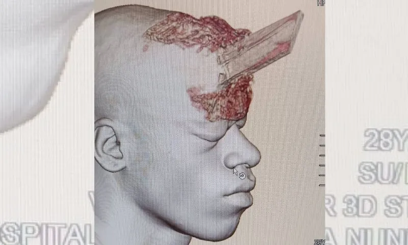 Imagem ilustrativa da imagem Pedreiro sobrevive após ter crânio perfurado por estaca de madeira no RJ