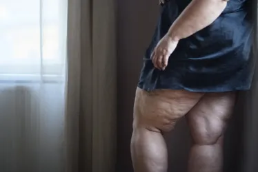 
          Imagem ilustrativa da imagem Alimentação, um dos pilares do tratamento do lipedema
          