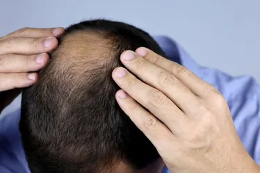 
          Imagem ilustrativa da imagem Células-tronco e o tratamento contra a calvície
          