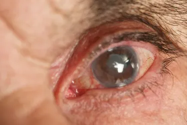 
          Imagem ilustrativa da imagem Conscientizar sobre o glaucoma é uma das formas de combatê-lo
          