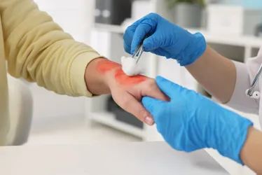 
          Imagem ilustrativa da imagem Queimaduras: prevenção é o melhor caminho
          