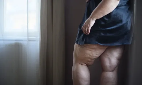 
          Imagem ilustrativa da imagem Alimentação, um dos pilares do tratamento do lipedema
          