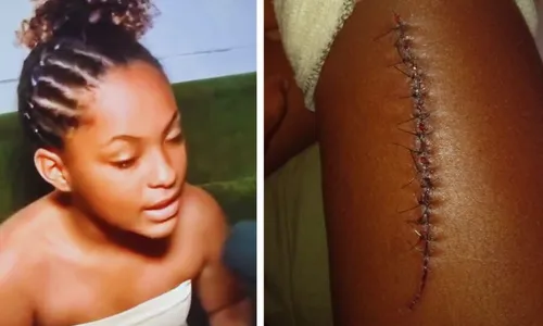 
          Imagem ilustrativa da imagem Canaletas quebradas provocam quedas e causam larvas em crianças do Recife
          