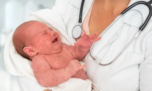 
          Imagem ilustrativa da imagem Cinco anos sem nenhum caso de sarampo no ES
          