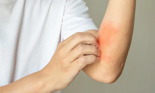 
          Imagem ilustrativa da imagem Quando a sarna vai além do prurido
          