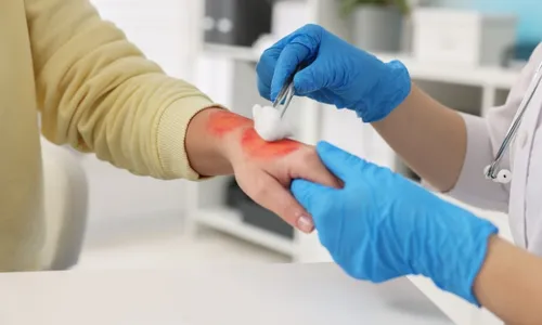 
          Imagem ilustrativa da imagem Queimaduras: prevenção é o melhor caminho
          