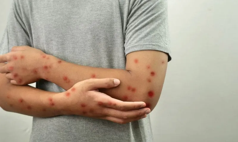 Imagem ilustrativa da imagem Saúde confirma primeiro caso de nova cepa de mpox no Brasil