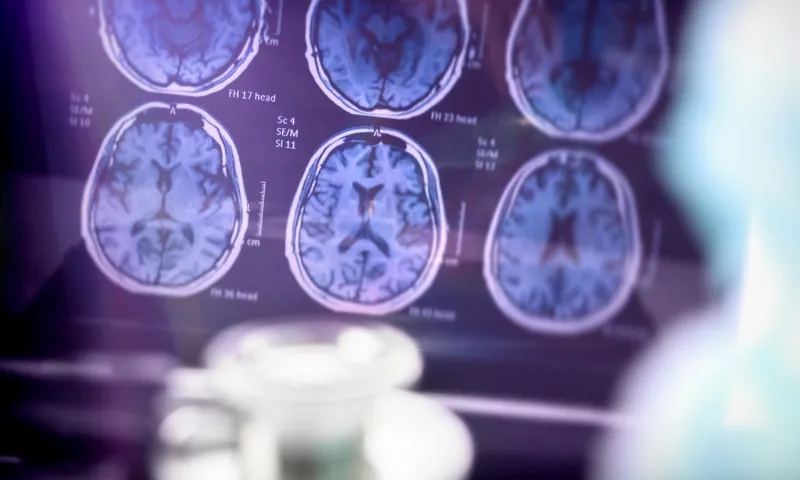 Imagem ilustrativa da imagem Anvisa aprova primeiro medicamento para tratar doença de Alzheimer