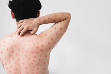 Imagem ilustrativa da imagem África tem quase 4 mil novos casos de mpox em uma semana e ainda não recebeu vacina
