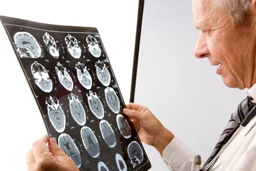 Imagem ilustrativa da imagem Estudo identifica tratamento promissor no combate a câncer cerebral sem cura