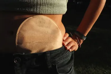 Imagem ilustrativa da imagem Fim do sofrimento? Barão de Lucena inicia atendimento especializado para ostomizado