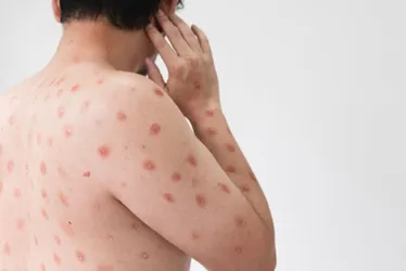 Imagem ilustrativa da imagem Governo do estado intensifica ações de combate à Dengue e monitora casos de Mpox