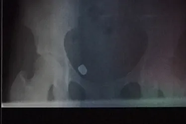 Imagem ilustrativa da imagem Grávida baleada em assalto em Linhares denuncia erro em cirurgia