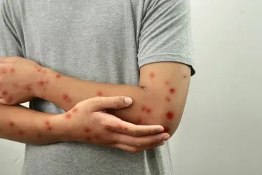 Imagem ilustrativa da imagem Mpox não é nova covid, diz diretor da OMS