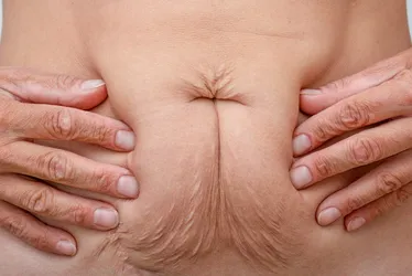 Imagem ilustrativa da imagem Saiba como melhorar a flacidez após perder peso