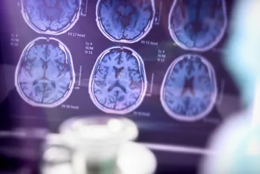 Imagem ilustrativa da imagem Anvisa aprova primeiro medicamento para tratar doença de Alzheimer