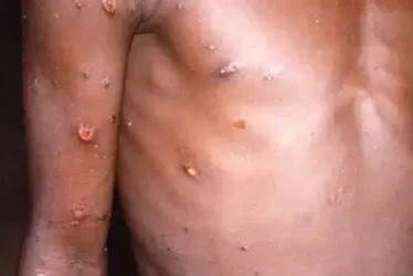 Imagem ilustrativa da imagem Suspeita de Mpox leva à suspensão de aulas em Paulista, mas governo evita alarme