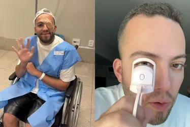 Imagem ilustrativa da imagem 'Terçol permanente' leva influencer a cirurgia após usar curvex; entenda infecção