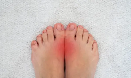 
          Imagem ilustrativa da imagem A lancinante crise de gota
          