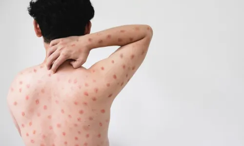 
          Imagem ilustrativa da imagem África tem quase 4 mil novos casos de mpox em uma semana e ainda não recebeu vacina
          