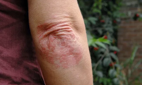 
          Imagem ilustrativa da imagem Especialistas ensinam como identificar e tratar a psoríase
          