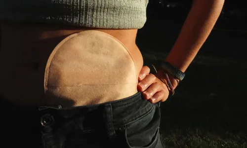 
          Imagem ilustrativa da imagem Fim do sofrimento? Barão de Lucena inicia atendimento especializado para ostomizado
          