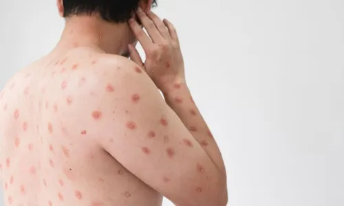 
          Imagem ilustrativa da imagem Governo do estado intensifica ações de combate à Dengue e monitora casos de Mpox
          