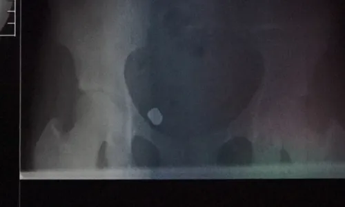 
          Imagem ilustrativa da imagem Grávida baleada em assalto em Linhares denuncia erro em cirurgia
          