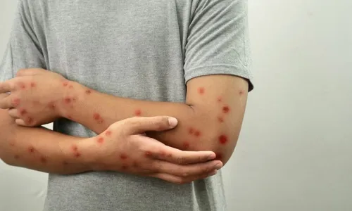 
          Imagem ilustrativa da imagem Mpox: entenda o que a OMS vai avaliar em reunião marcada para o dia 22
          