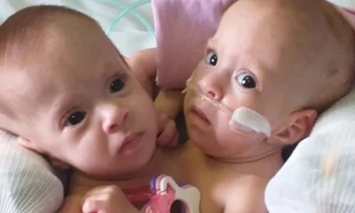 
          Imagem ilustrativa da imagem Siamesas ligadas pelo tórax deixam hospital pela primeira vez na vida em GO
          