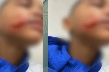 Imagem ilustrativa da imagem Mãe busca respostas após filho de 6 anos levar corte profundo em escola do Recife
