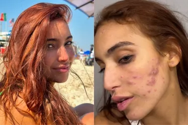 Imagem ilustrativa da imagem Vanessa Lopes fala sobre crise de acne: 'Não aguento mais'