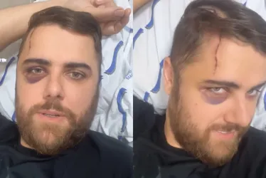 Imagem ilustrativa da imagem Zé Neto atualiza estado de saúde e mostra hematoma no olho após acidente