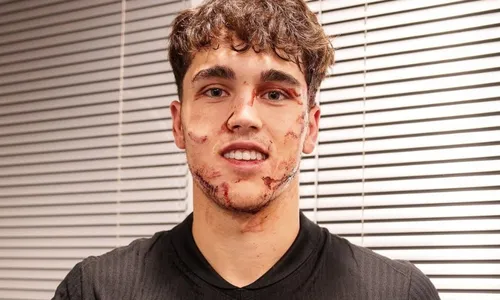 
          Imagem ilustrativa da imagem Jogador do Barcelona leva 10 pontos no rosto após choque na Liga dos Campeões
          