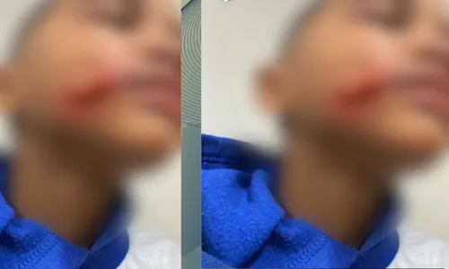 
          Imagem ilustrativa da imagem Mãe busca respostas após filho de 6 anos levar corte profundo em escola do Recife
          